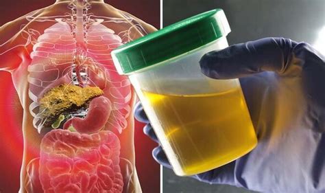 Liver Disease Early Symptoms Include Choluria That Can Crop Up In Your Pee Uk