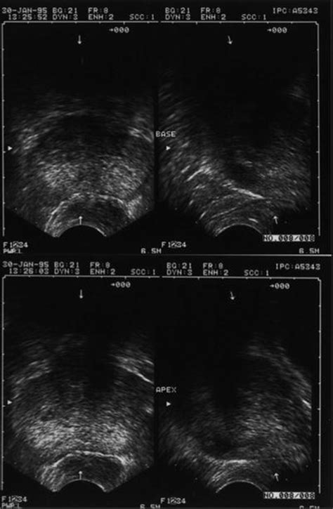 Transrectal Ultrasound Of The Prostate Radiology Key