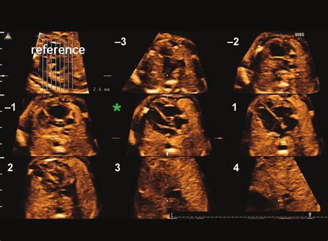 20 Tomographic Ultrasound Imaging In A Stic Volume In Diastole In A