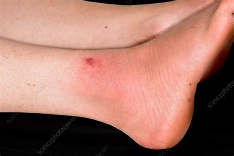 Swelling From Insect Bite Stock Image C0426327 Science Photo Library