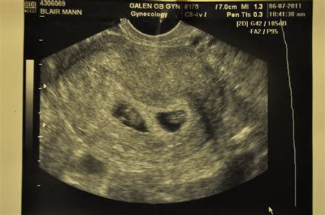 Little Mann Girls Ultrasound 7 Weeks