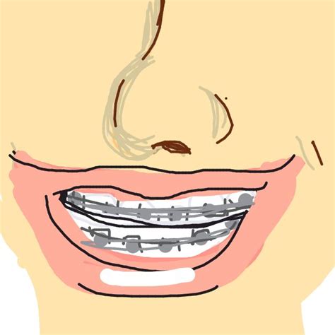 Braces Dental Art Orthodontics Dentistry