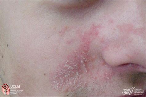 Dermatitis Seborreica Facial