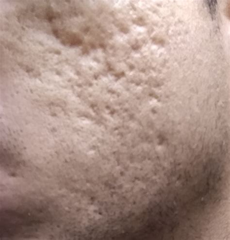 Need Help In Treating Acne Scars Scar Treatments