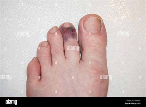 Male Adult Left Foot With Stubbed And Badly Bruised Index Toe On A