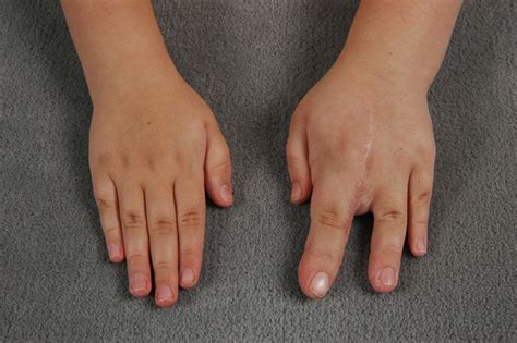 Macrodactyly Big Fingers Congenital Hand And Arm Differences