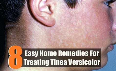 8 Easy Home Remedies For Treating Tinea Versicolor Search Home Remedy