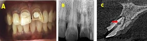 Internal And External Resorption Of Teeth Teethwalls