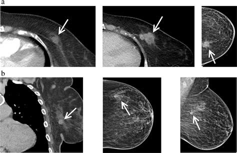 The Chest Radiologists Role In Invasive Breast Cancer Detection