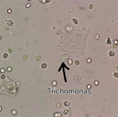 Trichomonas In Urine