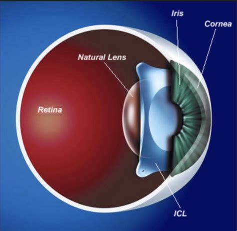 Implantable Contact Lens Icl Specialist Manhattan Ny And Long Beach