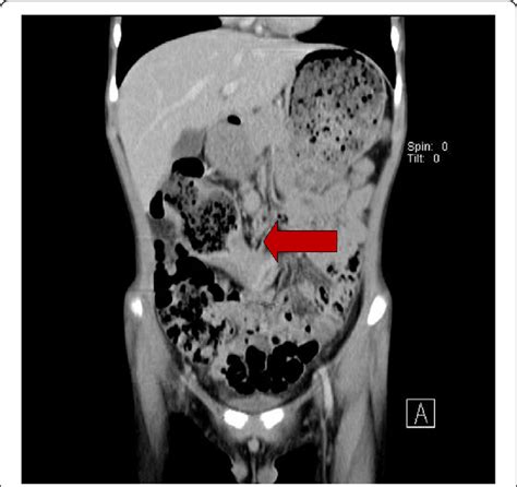 Contrast Enhanced Computed Tomography Ct Scan Of The Abdomen And