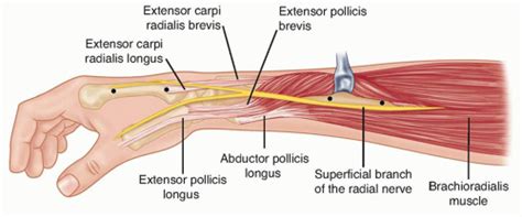 Radial Sensory Nerve Entrapment