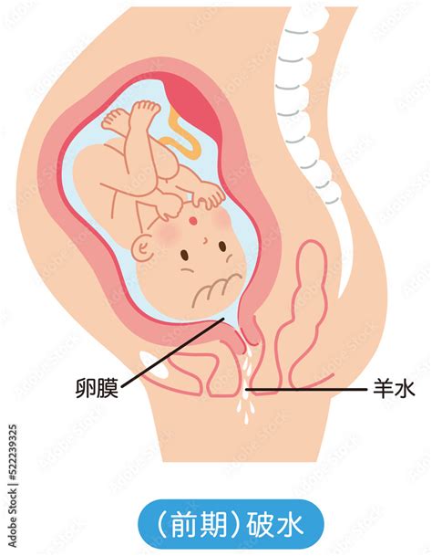 illustrazione stock 前期破水 子宮の中の赤ちゃん 妊娠中の母体の仕組み adobe stock