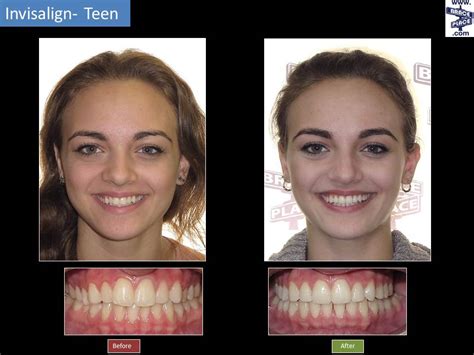 Before And After Photo With Invisalign Treatment Braces Invisalign My Xxx Hot Girl