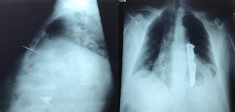 1 Trauma Penetrante Torax Radiografia Uniportalvats Ocronos Editorial Científico Técnica
