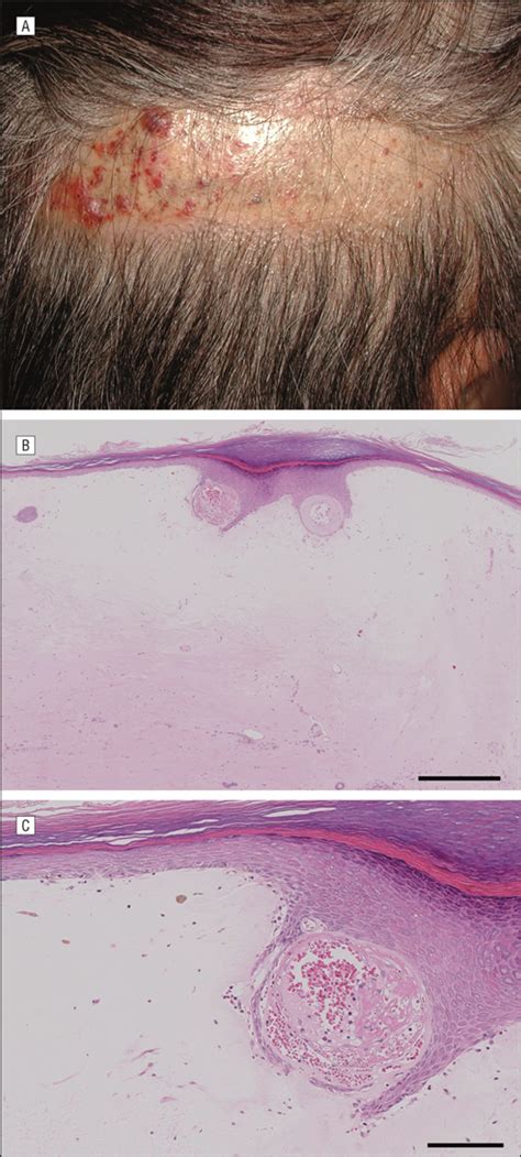 A Case Of Lichen Sclerosus Of The Scalp Associated With Autoantibodies