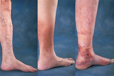 Types Of Varicose Veins In Legs