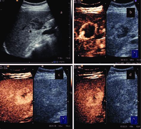 Ceus In A Benign Lesion Hemangioma A Conventional Ultrasound