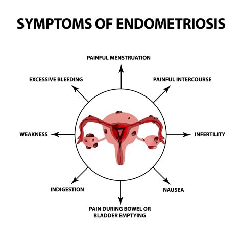 Endometriosis And Latest Prospective Treatment Of Options