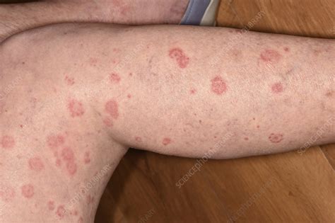 Erythema Multiforme Target Lesions Stock Image C0498495 Science Photo Library