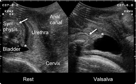 Pelvic Floor Ultrasound A Review American Journal Of Obstetrics