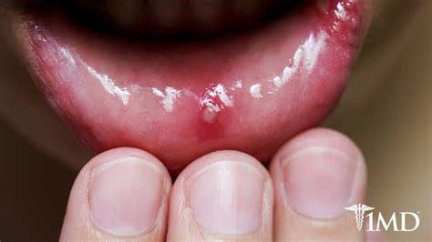 How To Tell If Its A Canker Sore Cold Sore Or More Serious 1md