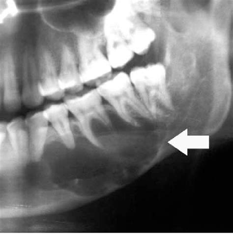 Odontogenic Keratocyst In A 36 Year Old Woman Panoramic Radiograph