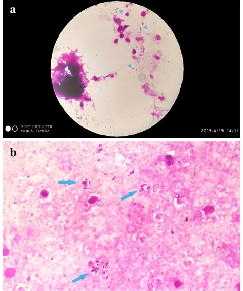 A Gram Negative Bacilli In Renal Pelvis Urine Gram Staining In A