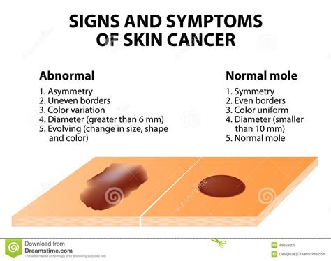 Signs And Symptoms Of Skin Cancer Stock Vector Illustration Of