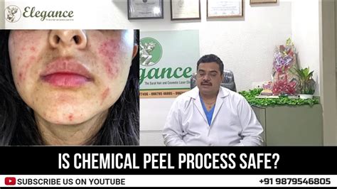 Let's watch it happen together!🌈 win a chance to be flown with a friend to meet me!!!! Is Chemical Peel Process Safe? by Dr. Ashutosh Shah ...
