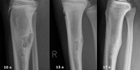 Bone Sarcoma Way To Heal