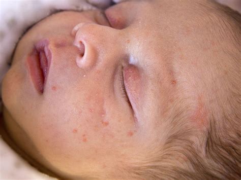 Newborn And Baby Rashes Eczema Acne And Other Skin Conditions Babycenter