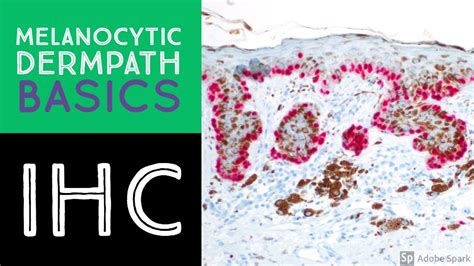 Melanocytic Dermpath Basics Immunohistochemistry Youtube