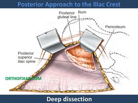 Posterior Approach To The Iliac Crest 2023 Orthofixar