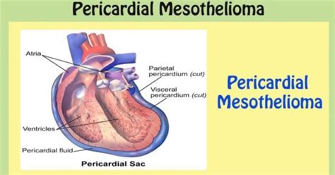 Pericardial Mesothelioma Mesothelioma Affecting The Heart