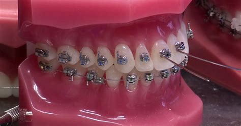 Do It Yourself Braces For Teeth Dont Be Tempted By Diy Braces Six