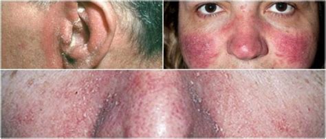 Treating Seborrheic Dermatitis On Face Causes Symptoms Treatment