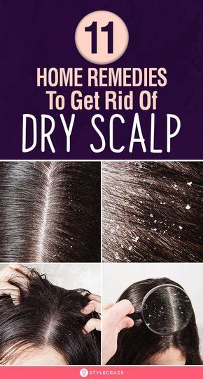 Dry Scalp Remedy Artofit