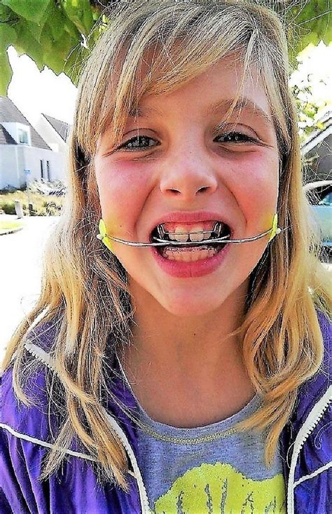dental braces teeth braces beautiful smile braces girls cleft lip lil girl hairstyles