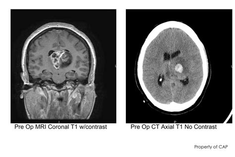 Glioblastoma Brain Tumour That Took Gord Downies Life Tough To Treat