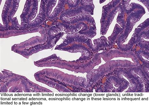 Pathology Outlines Tubulovillous Villous Adenoma