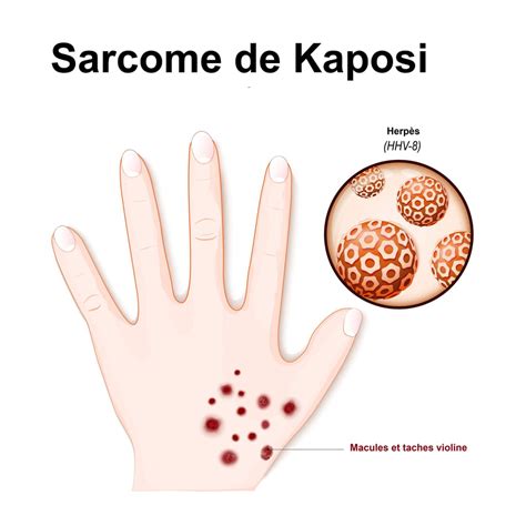 Sarcome De Kaposi Symptômes évolution Transmission