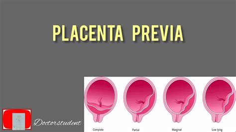 Placenta Previa Third Trimester Vaginal Bleeding Part 1 Youtube