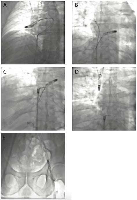 Successful Percutaneous Retrieval Of A Leadless Pacemaker From The