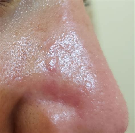 Tried Removing Sebaceous Hyperplasia On Nose And Now I Have Slightly