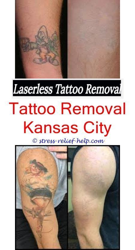 This is why it's very important to remove the pigment safely using the fewest laser. How do permanent tattoos get removed.How much does it cost ...
