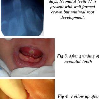 The ulcer may be uncomfortable but it is otherwise harmless. (PDF) Riga-Fede Disease