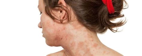 Atopowe zapalenie skóry to choroba uwarunkowana genetycznie Główne objawy to suchość skóry