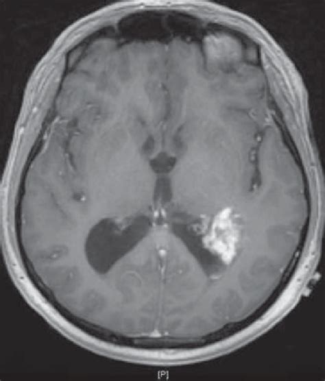 Solitary Lesion Within The Atrium Of The Left Lateral Ventricle And